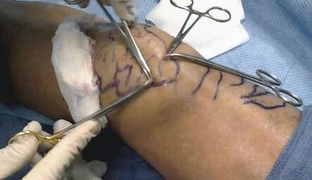 Cirurgia para varizes