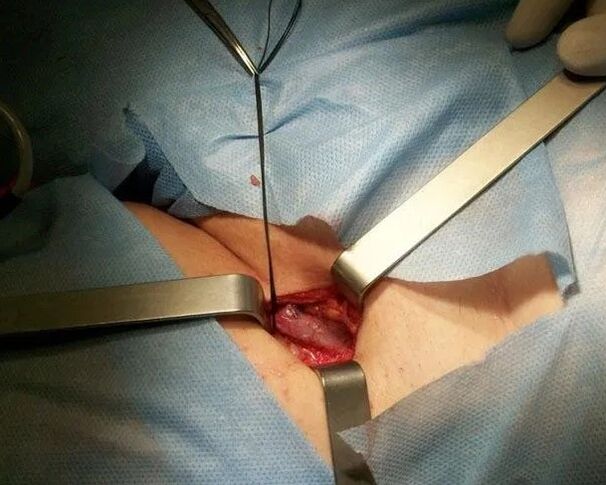 Croscectomy