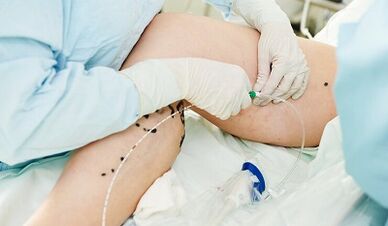 Métodos para o tratamento de varizes nas pernas nas mulheres