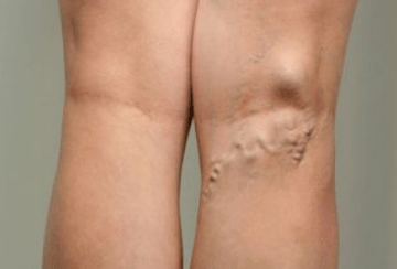 Diagnóstico de varizes em mulheres grávidas