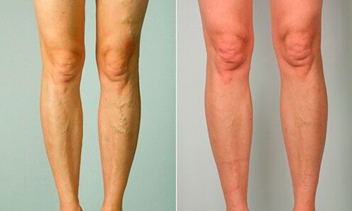 antes e depois do tratamento para varizes