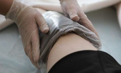 tratamento de varizes com compressas