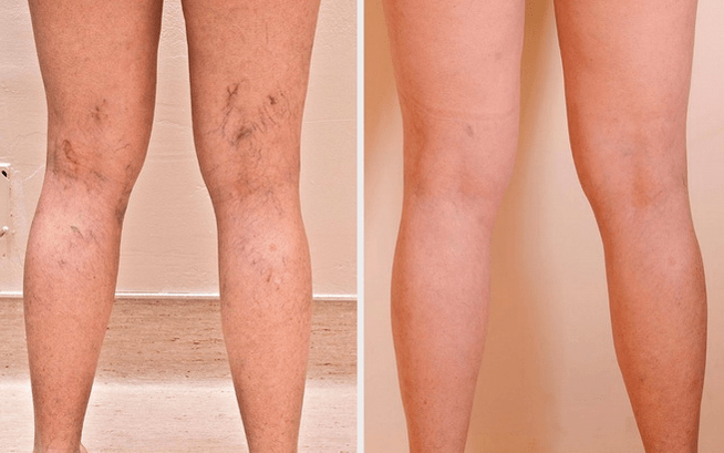pernas antes e depois do tratamento para varizes