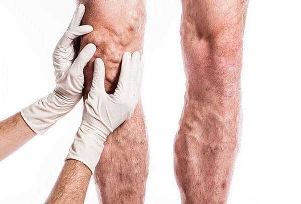 Palpação de varizes nas pernas