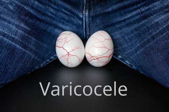 Varicocele – dilatação das veias do cordão espermático